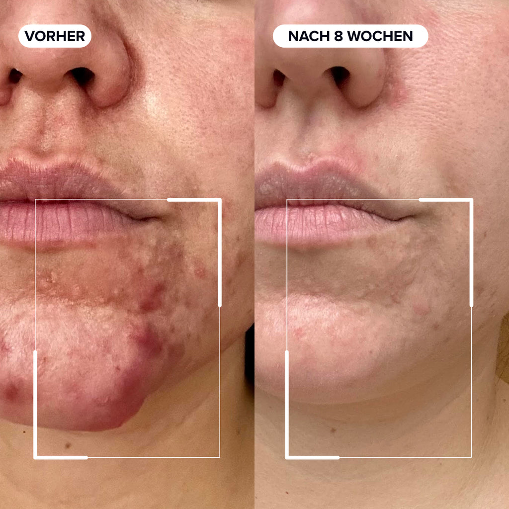 Dermabacs®